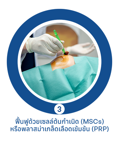 ฟื้นฟูข้อเข่าเสื่อมด้วยเซลล์และเกล็ดเลือด